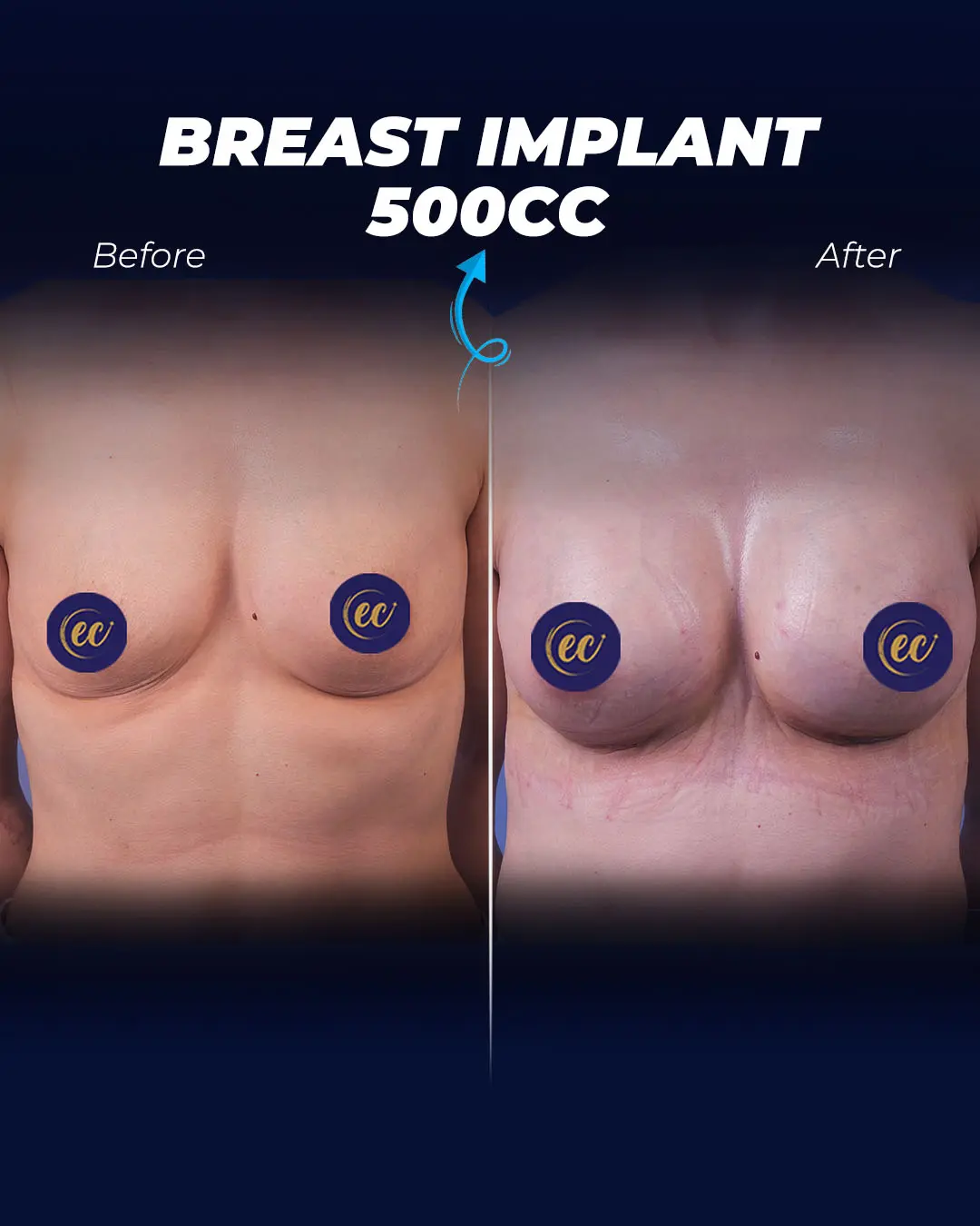 Breast Implants 500CC-Round