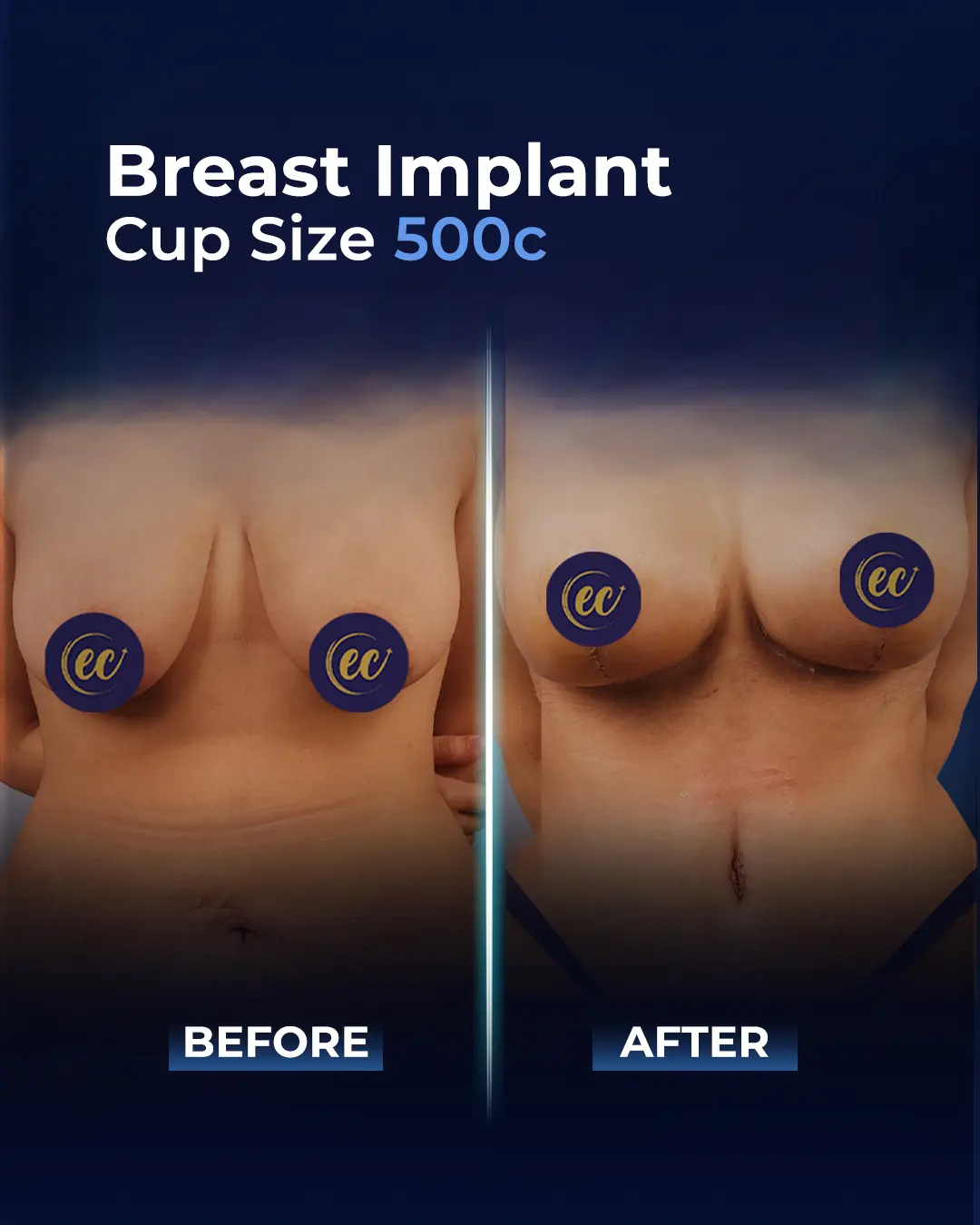 Breast Implants 500CC-Round
