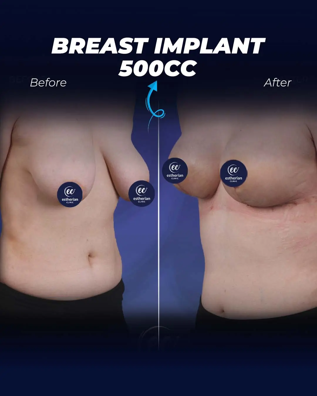 Breast Implant 500CC- Round