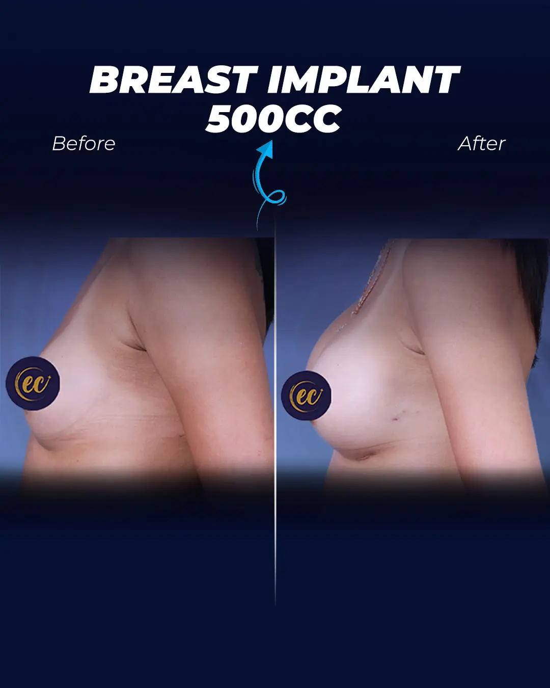 Breast Implants 500CC-Teardrop