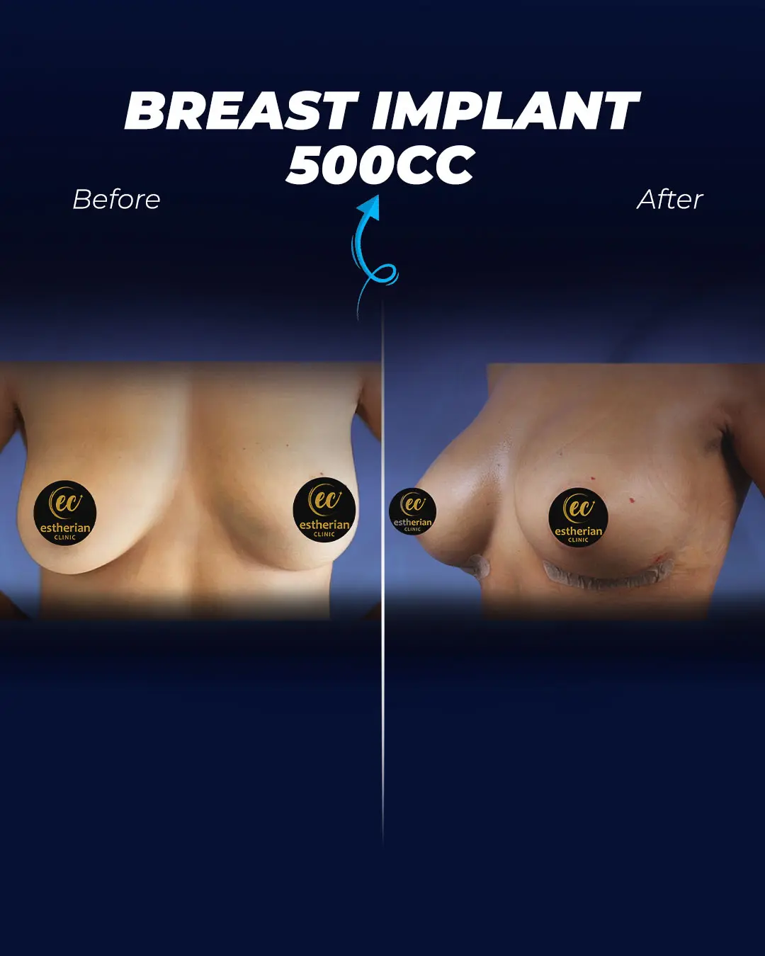 Breast Implants 500CC-Teardrop