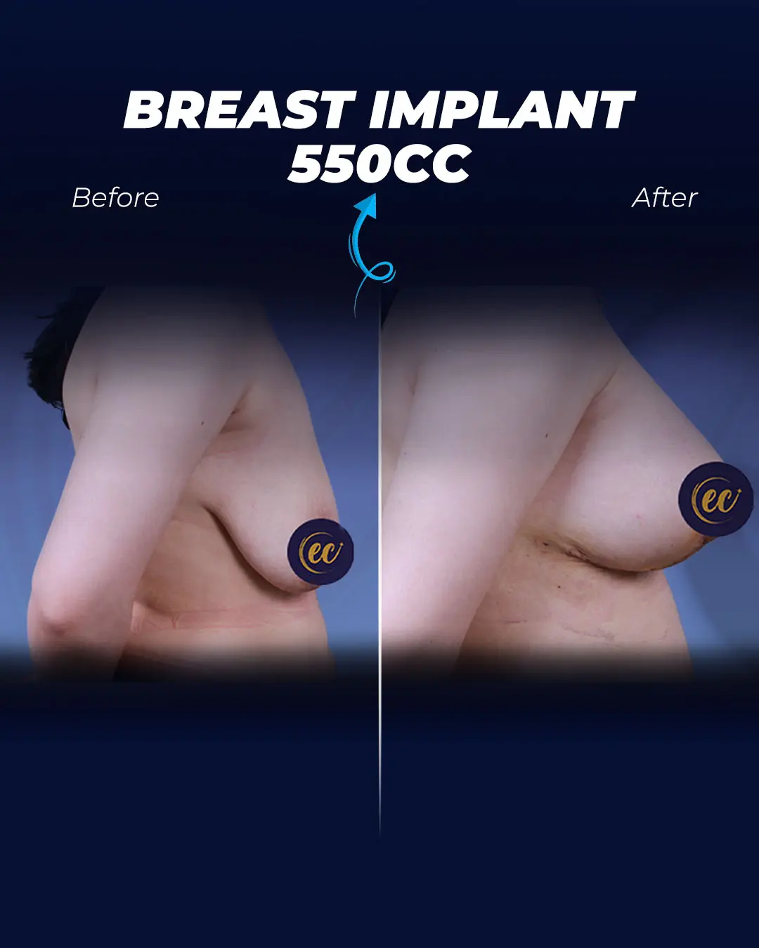 Breast Implants 550CC-Teardrop