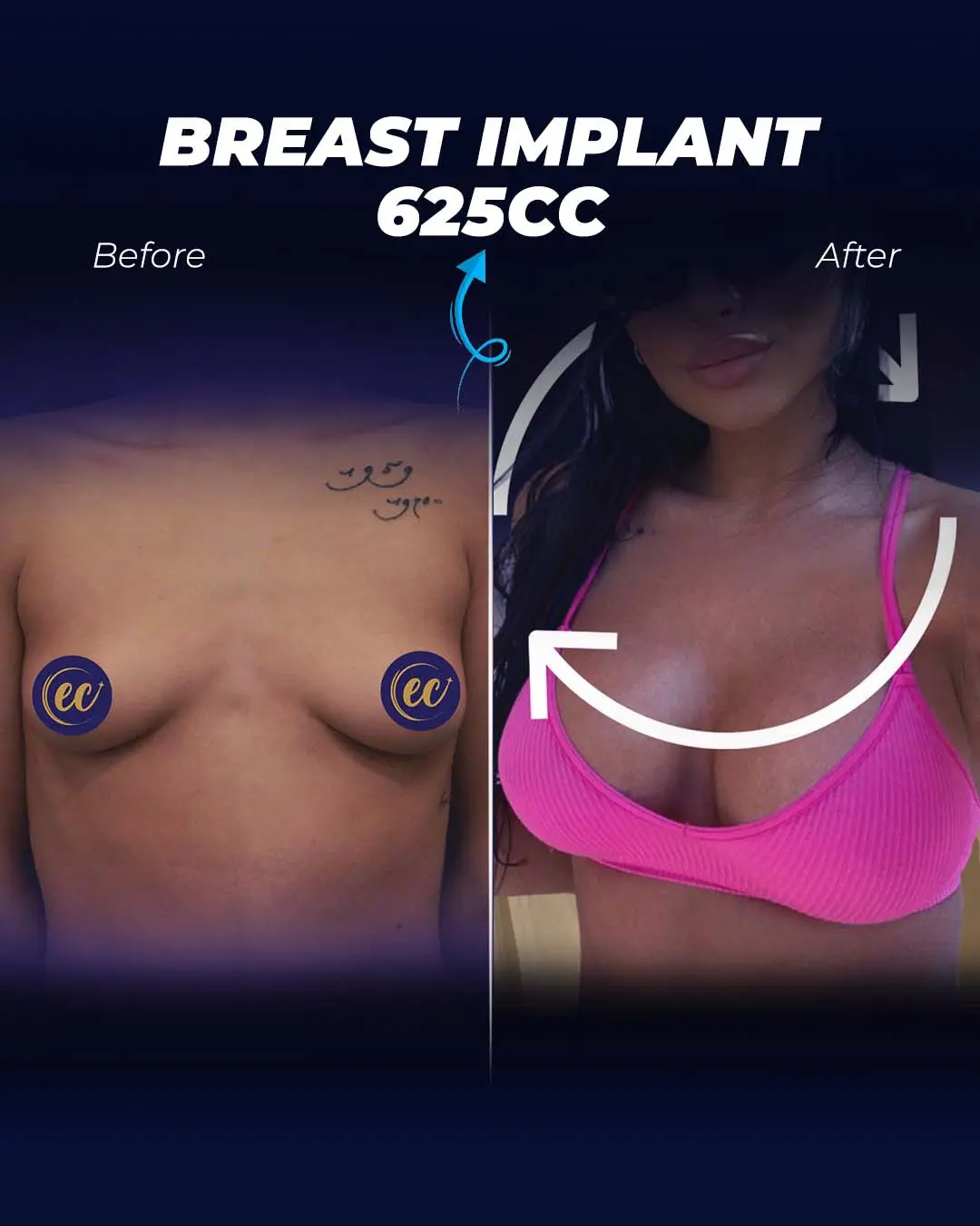 Breast Implants 625CC-Round
