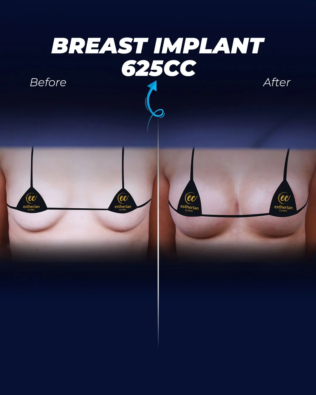 Breast Implants 625CC-Round