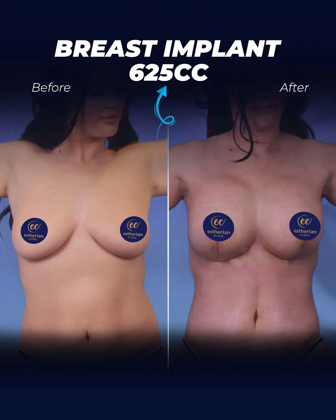 Breast Implants 625CC-Teradrop