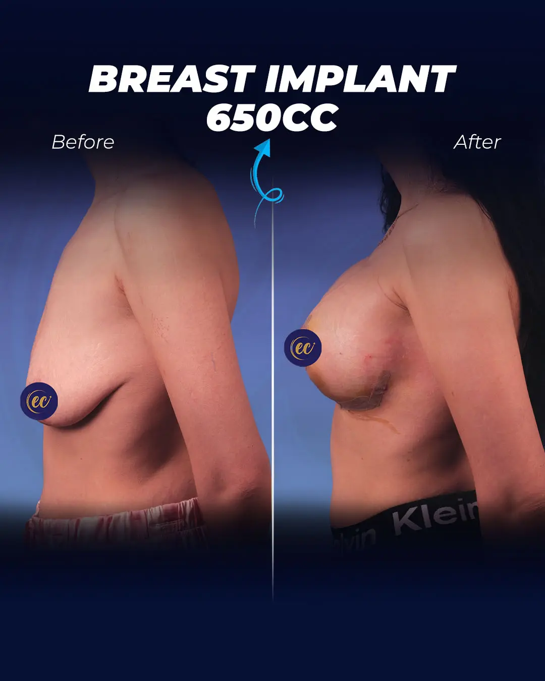 Breast Implants 650CC-Round