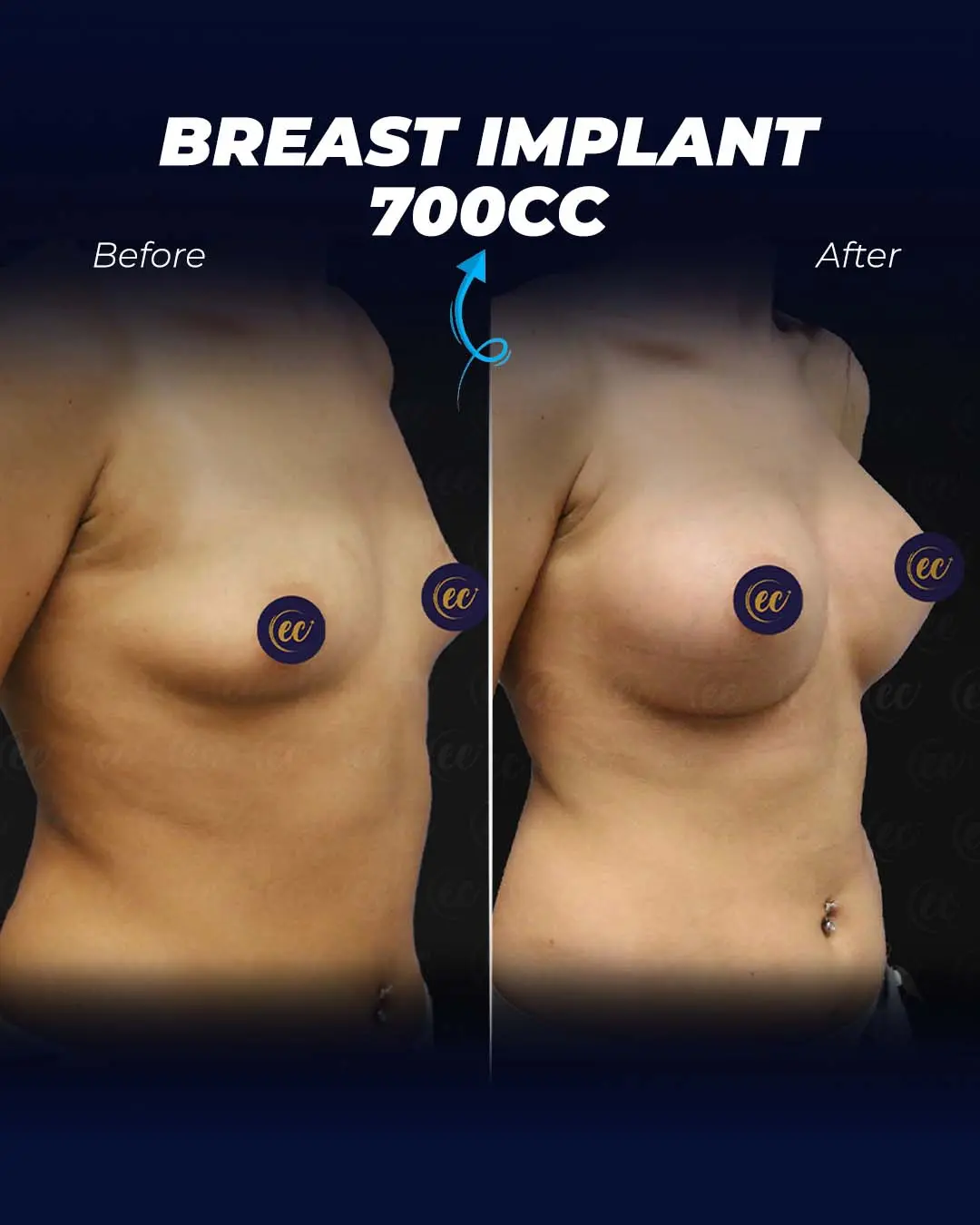 Breast Implants 700CC-Round