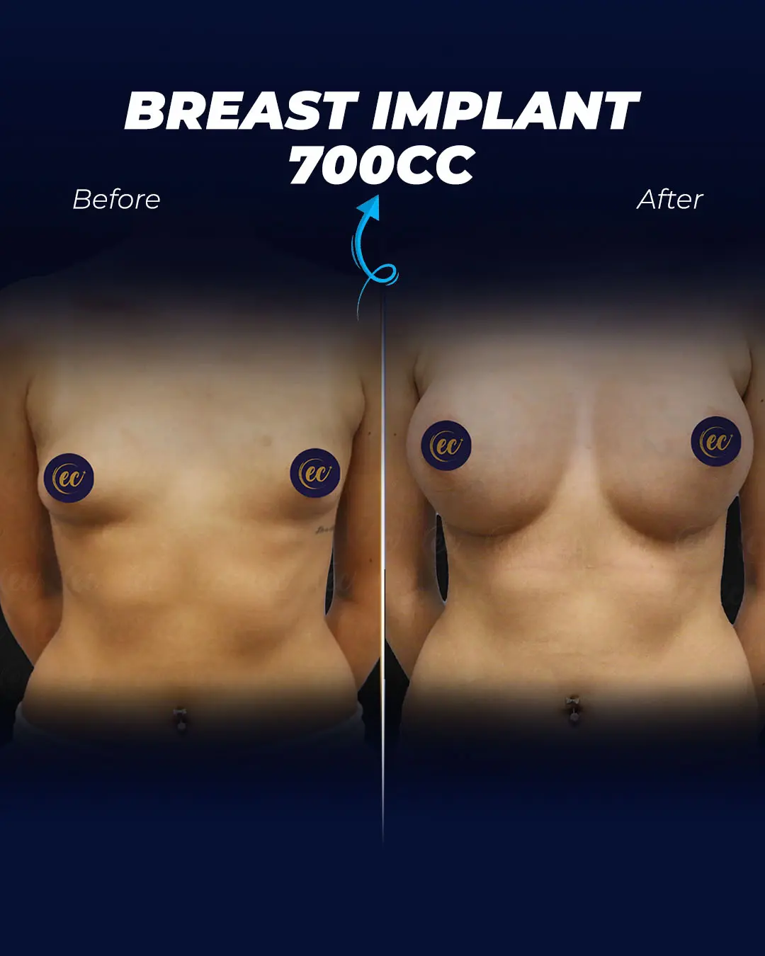 Breast Impalnts 700CC-Round