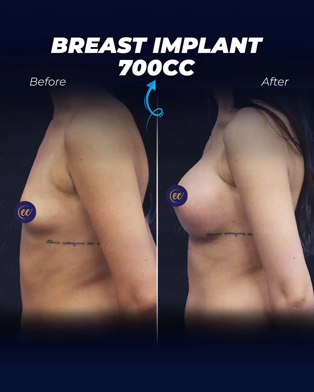 Breast Implants 700CC-Teardrop