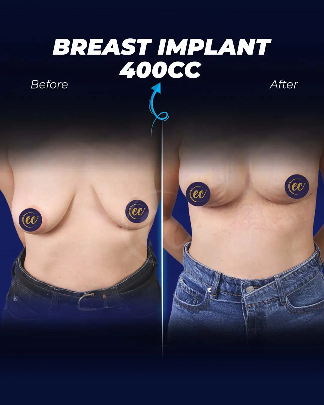 Breast Implants 400CC-Round