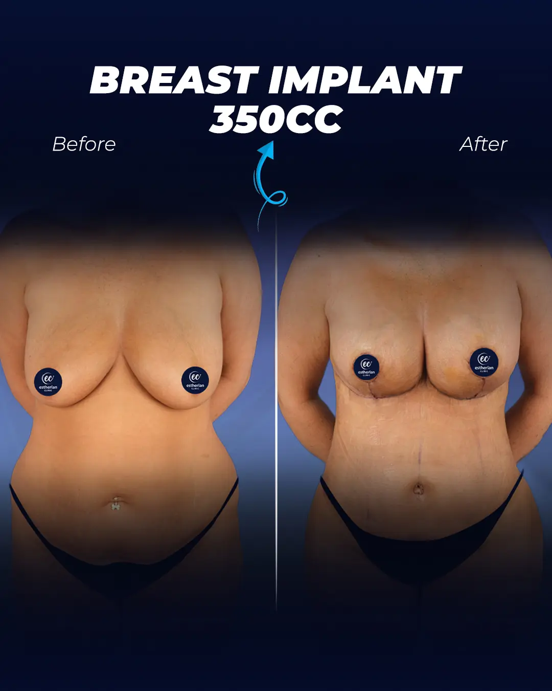 Breast Implants 350cc-Round