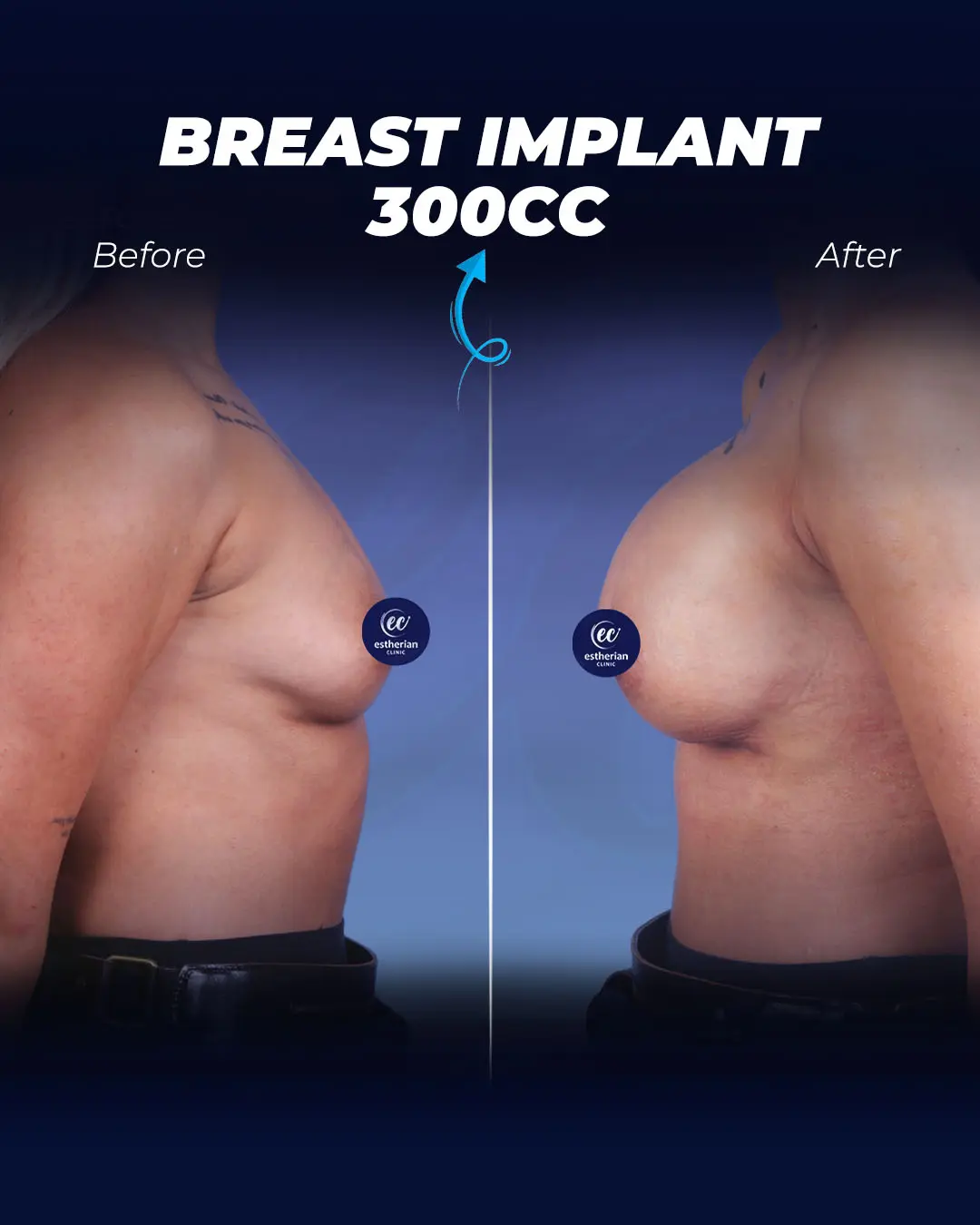 Breast Implants 300cc-Round