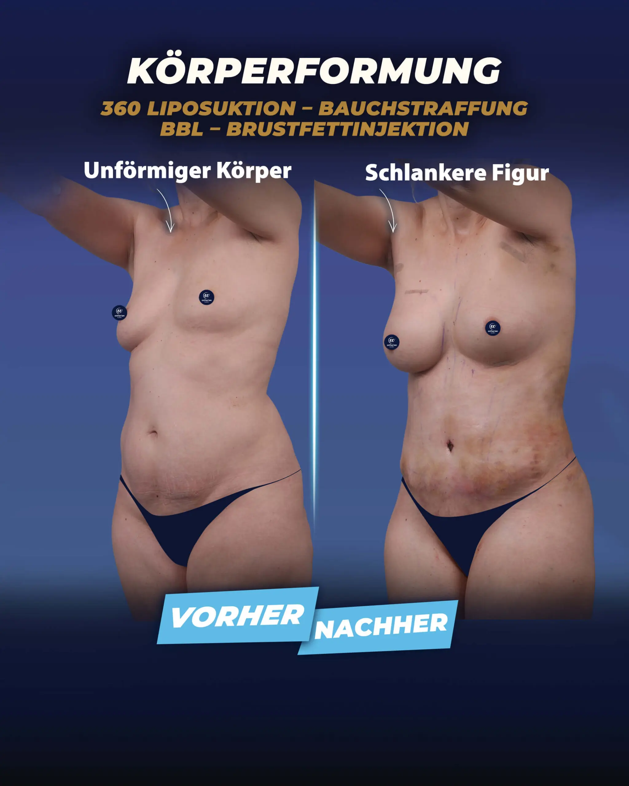 Eigenfetttransplantation zur Brust (Brustvergrößerung) Vorher-Nachher-Bilder der Estherian Klinik.jpeg