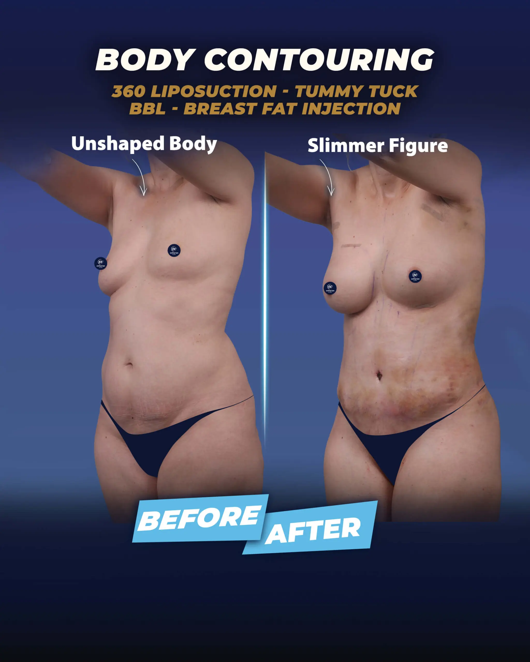 Fat Transfer to the Breasts (Breast Augmentation) Before-and-after by the Estherian Clinic.jpeg