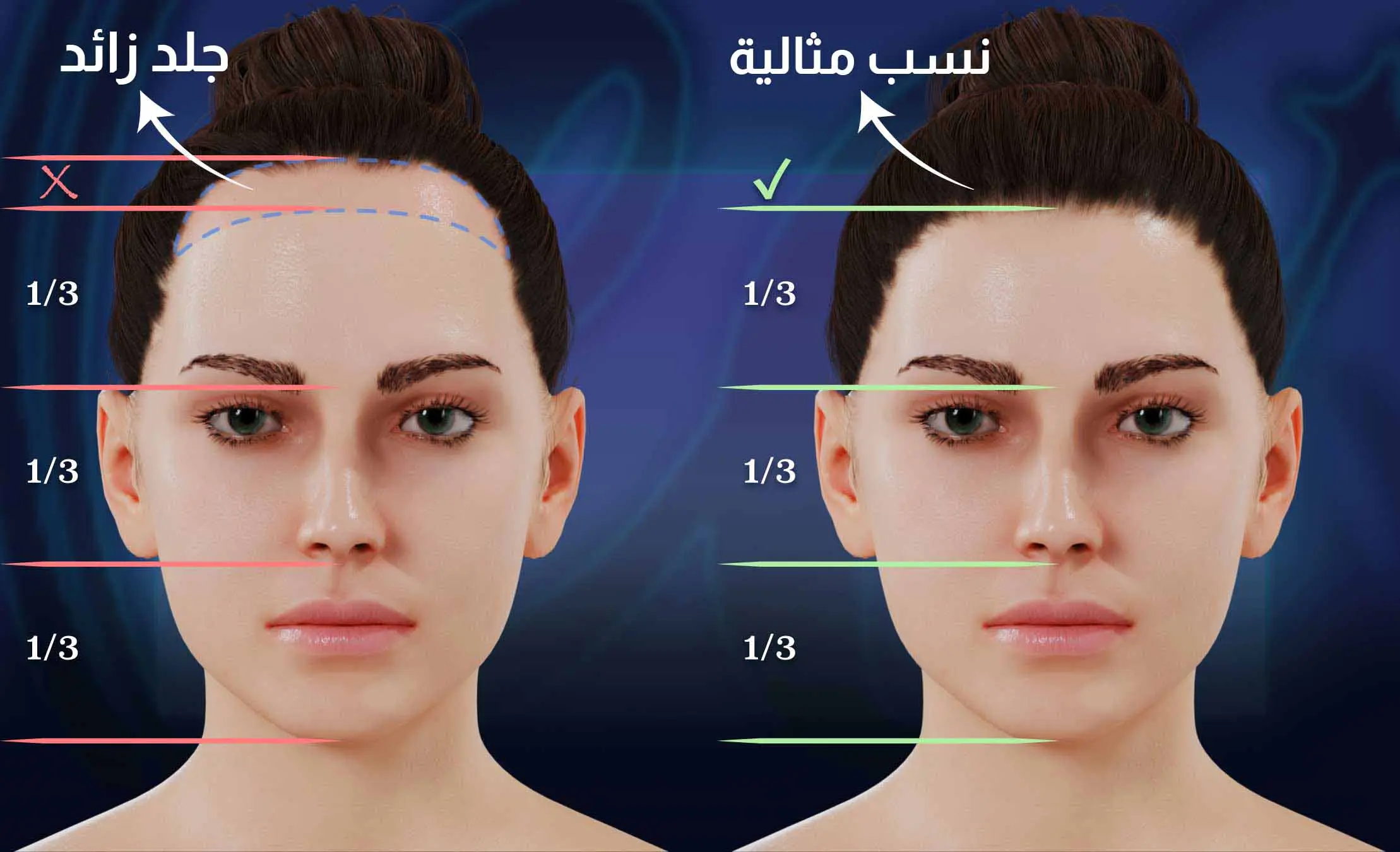 جراحة خفض خط الشعر