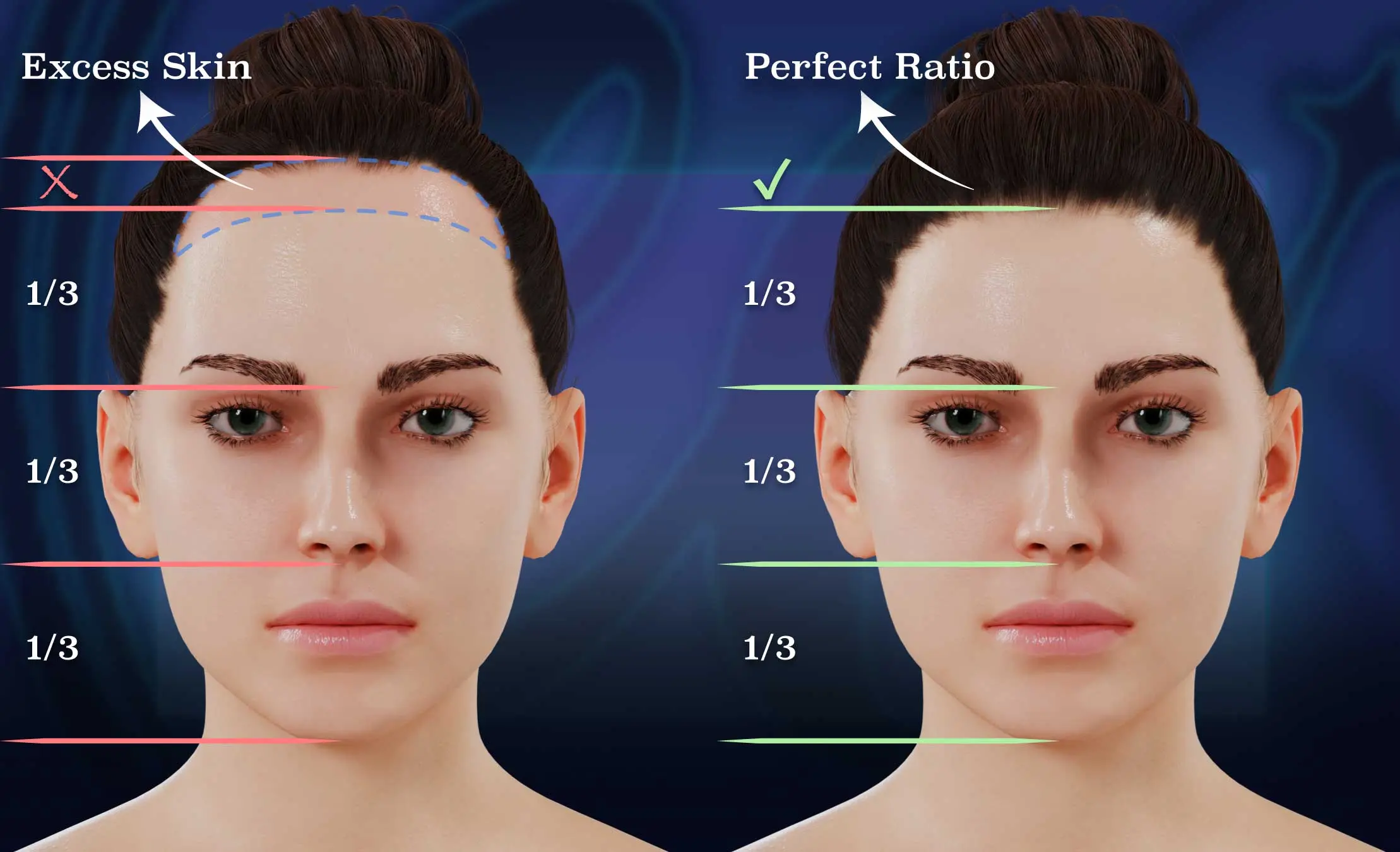 Hairline Lowering Surgery