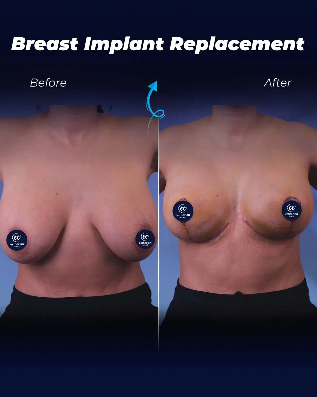 Implant Replacement Before and after