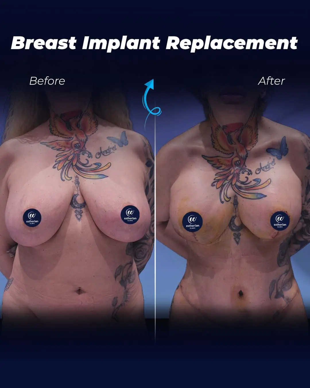 Implant Replacement Results