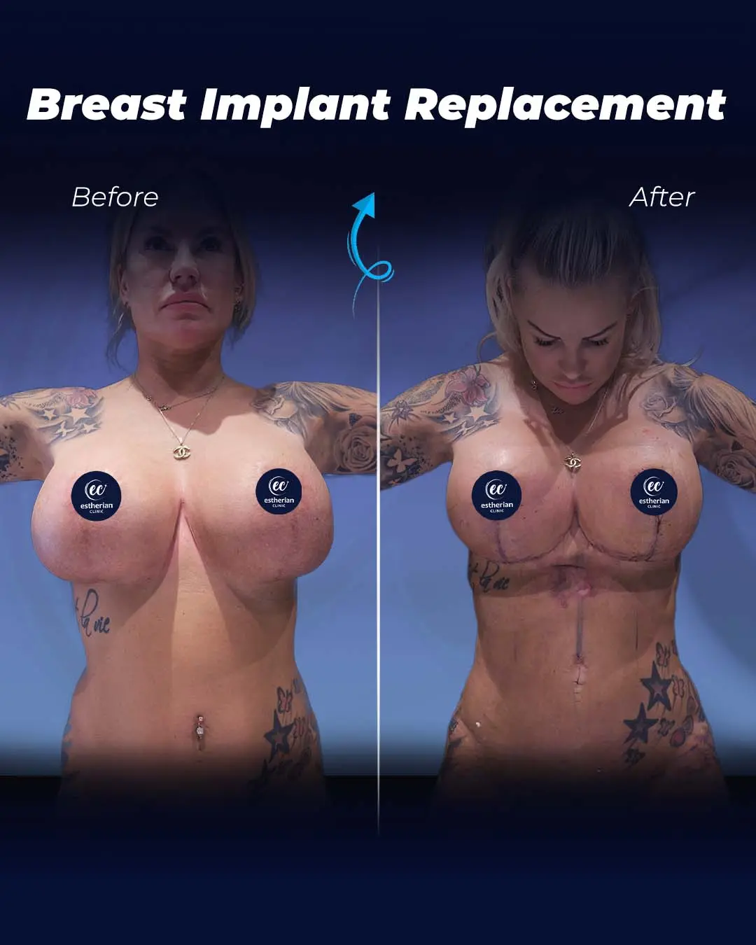 Implant Replacement Transformation
