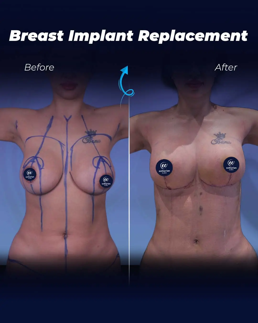 Implant Replacement