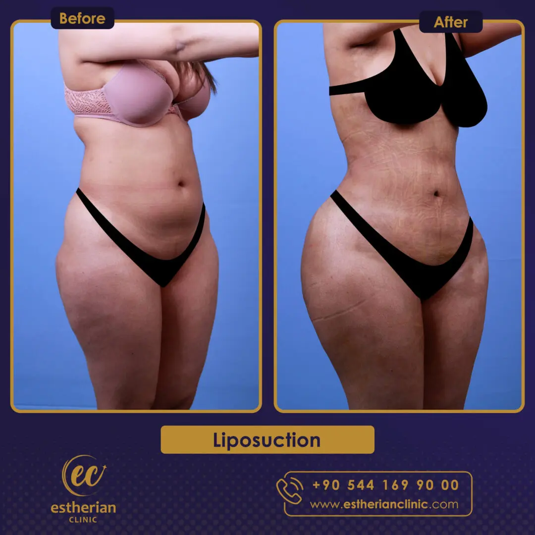 Liposuction öncesi ve sonrası
