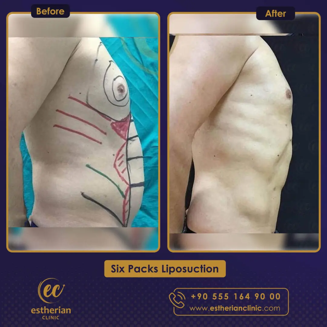 Estherian Kliniği Six-Pack Prosedürü Sonuçları