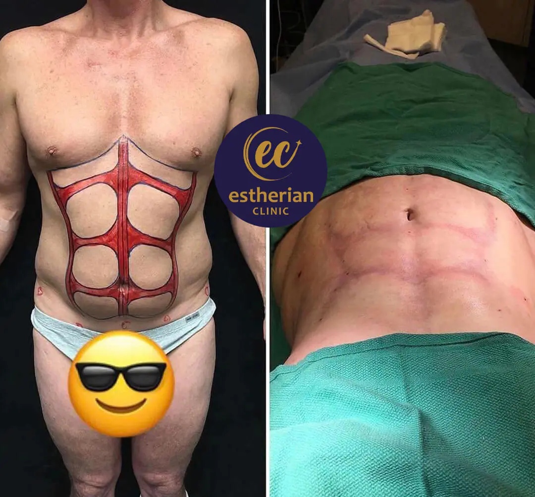 Ergebnisse der Sixpack-OP in der Estherian-Klinik