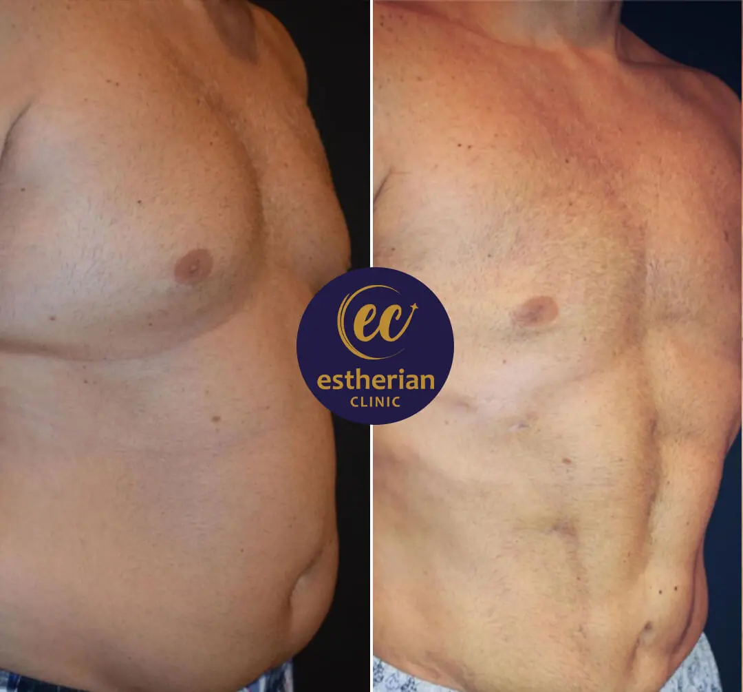 Résultats de la chirurgie des abdominaux en six-pack