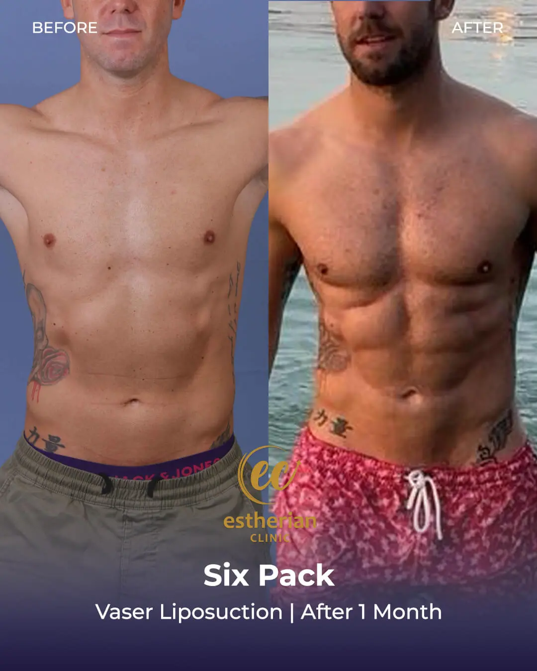 Six-pack surgery Vaser Liposuction (before and after) 1 Month post-op