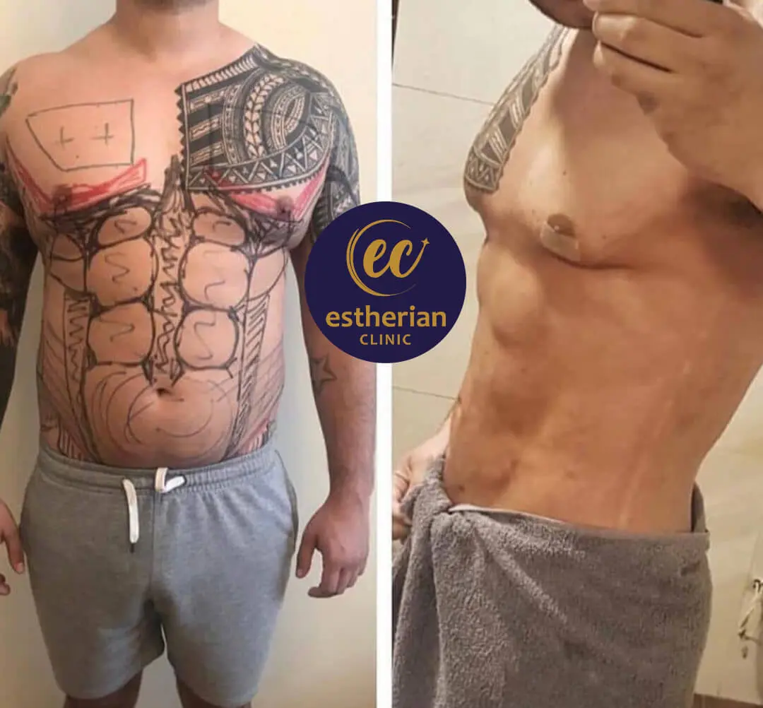 Ergebnisse der Sixpack-OP