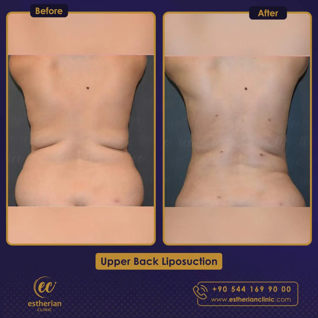 Résultats de la liposuccion du haut du dos