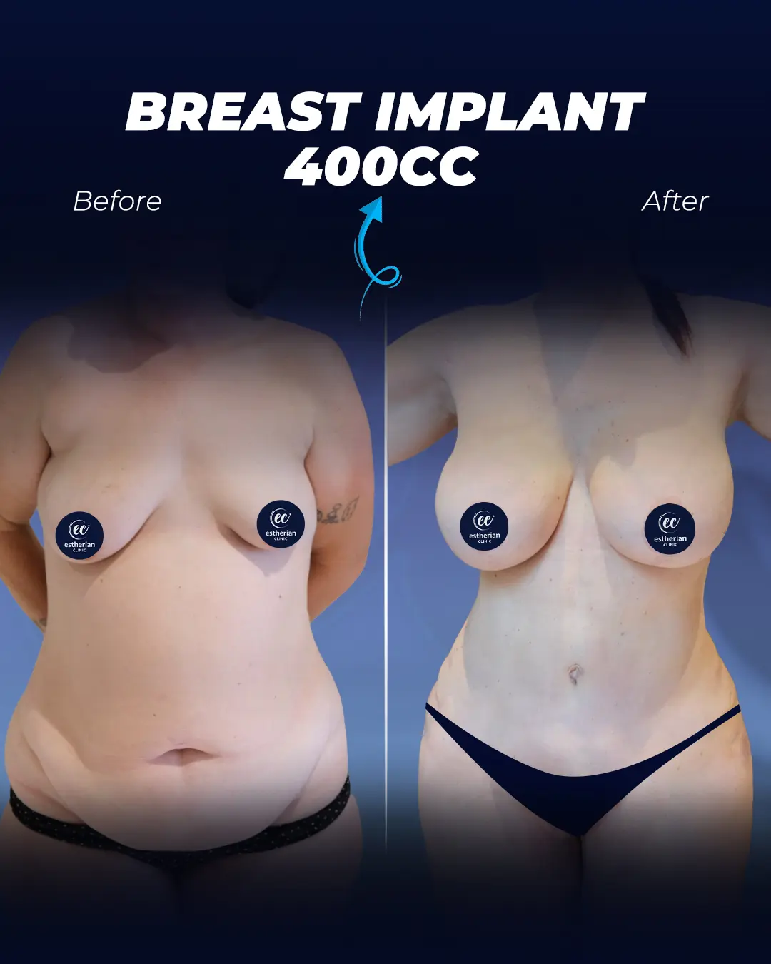 Breast Implants 400CC- Teardrop