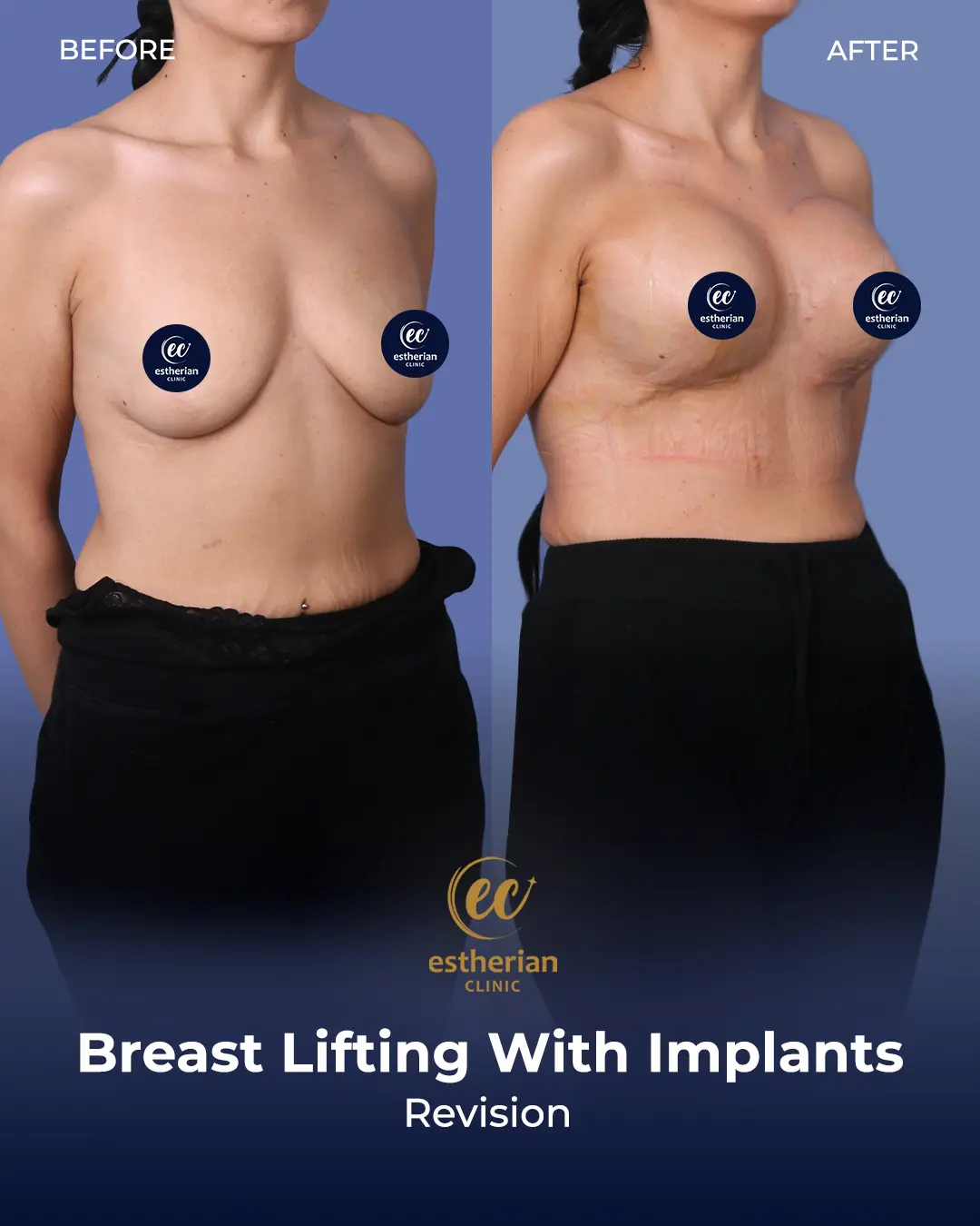 Breast lift with implants (Revision)