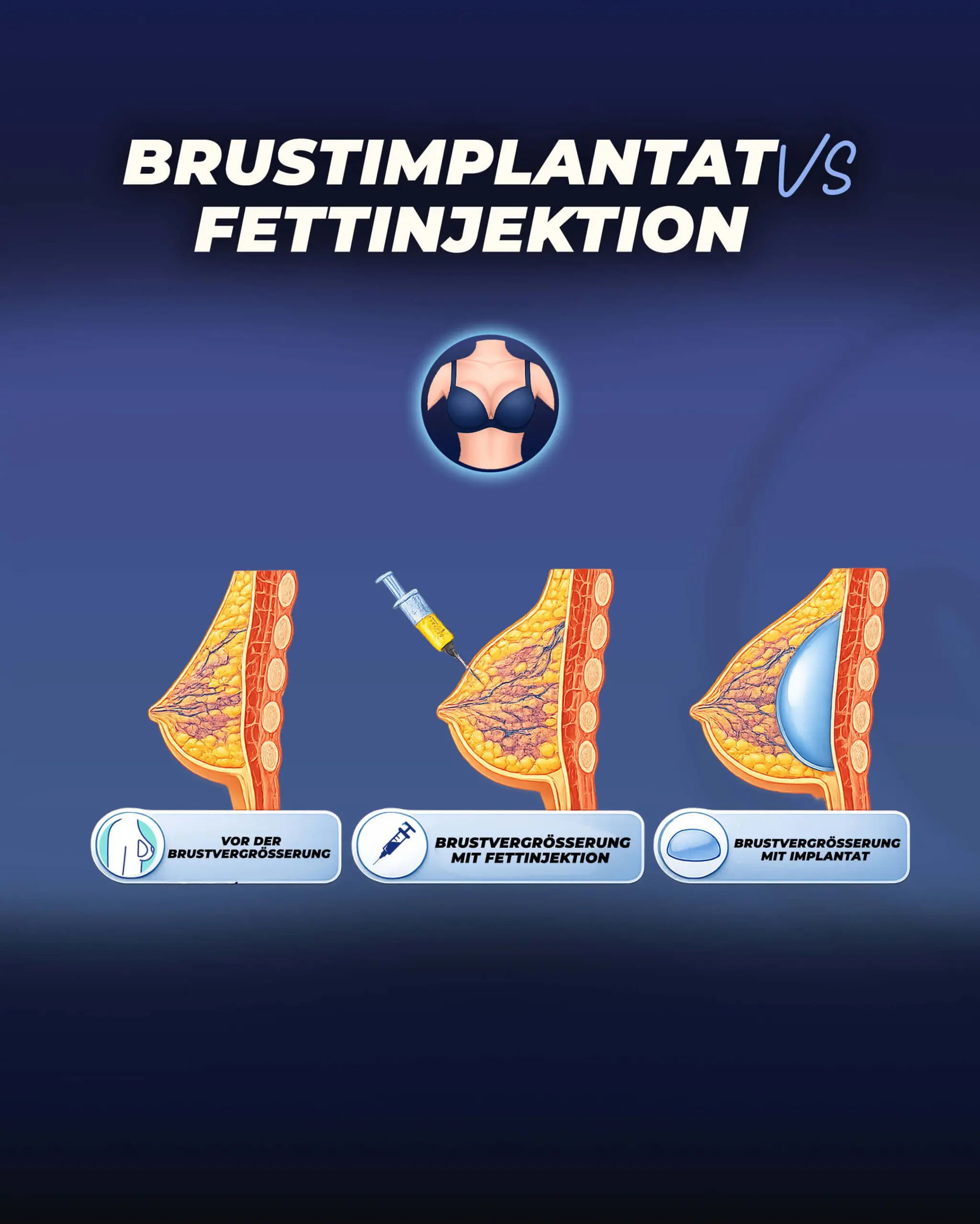 Brustimplantat vs. Eigenfetttransfer