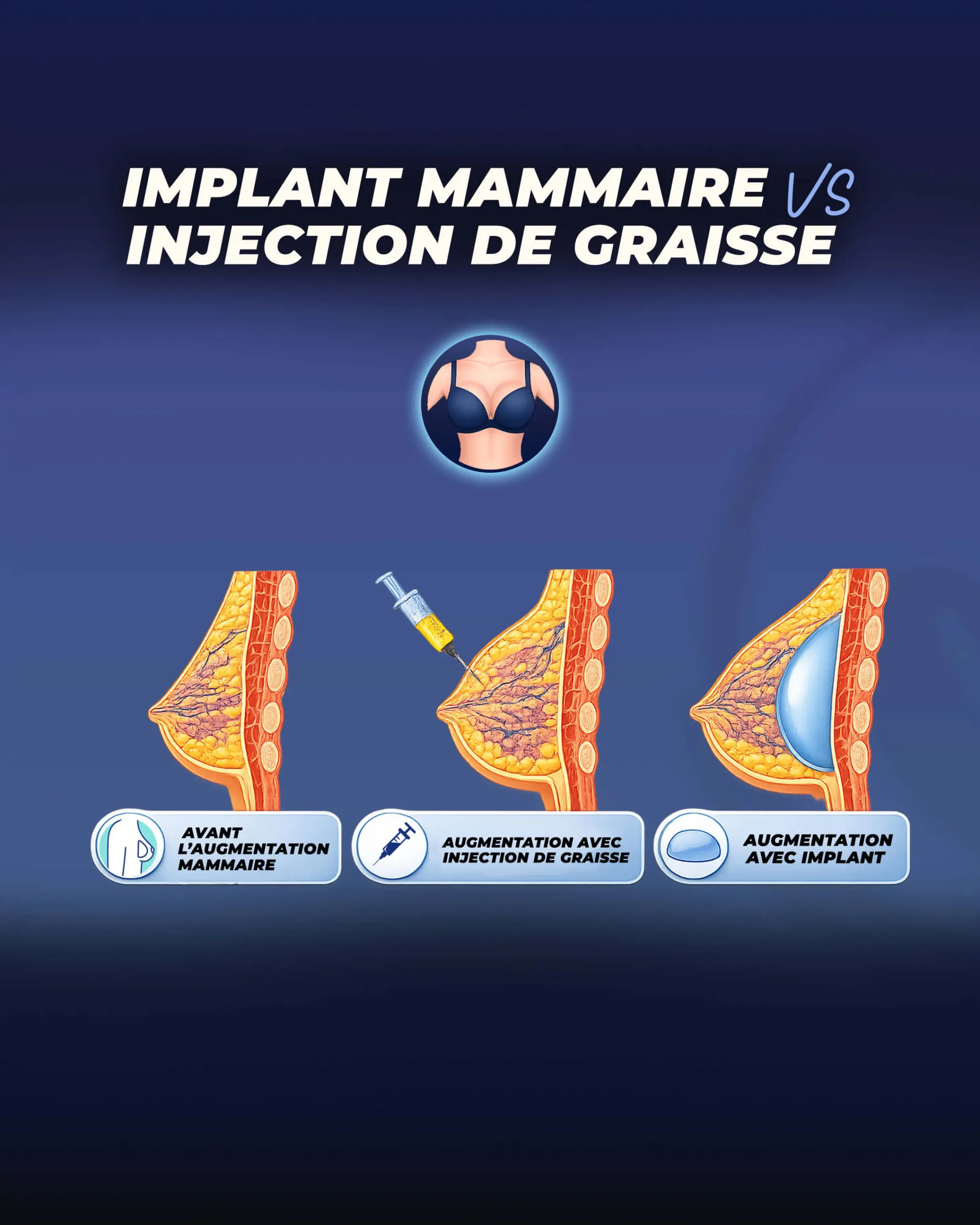implants mammaires vs transfert de graisse