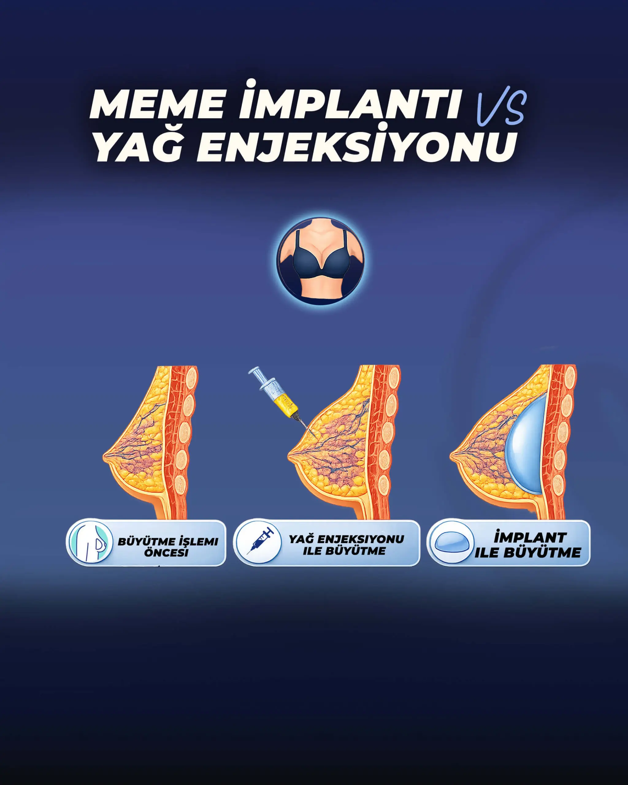 breast-implant-vs-Fat-Transfer-Tr.jpeg