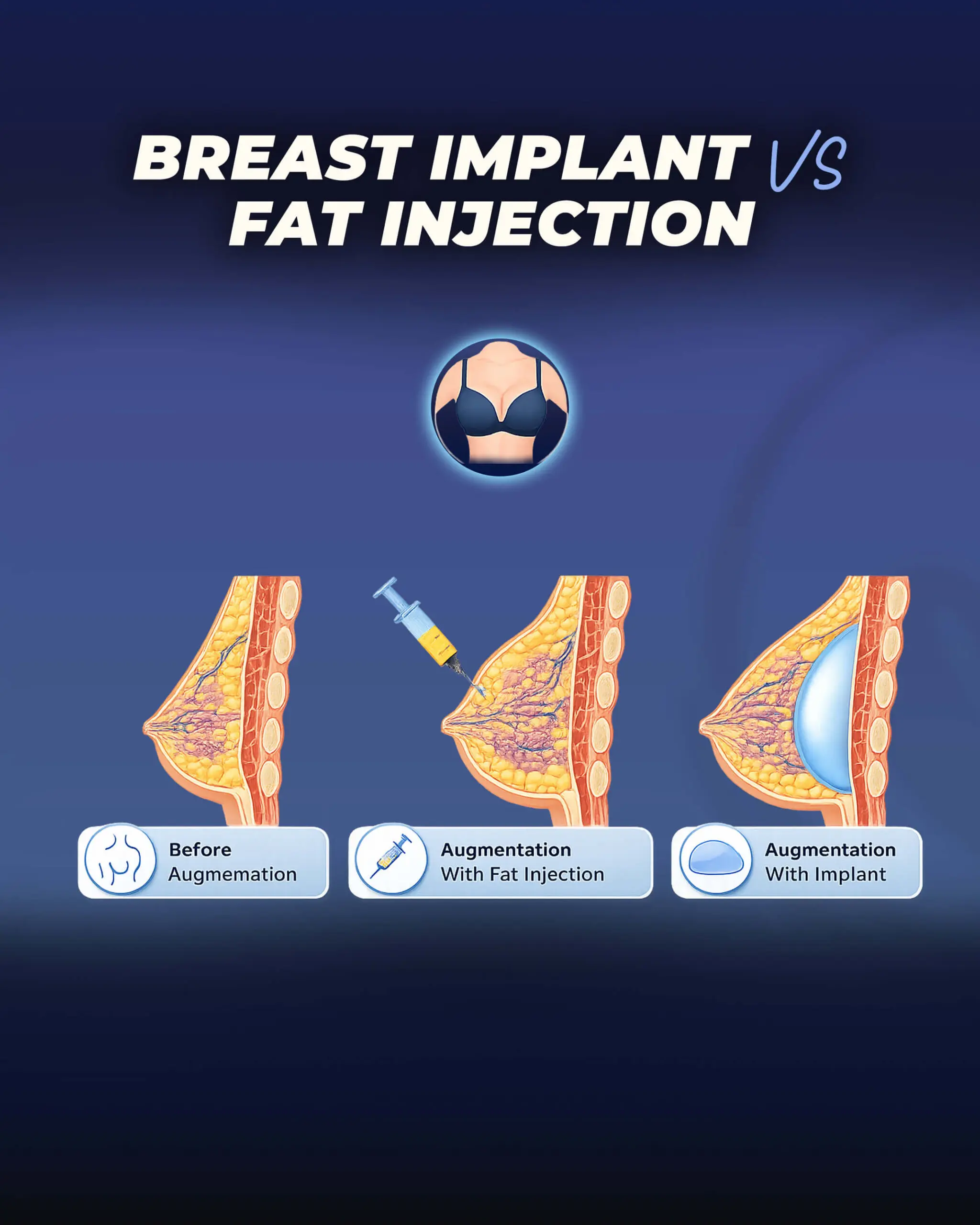 breast-implant-vs-Fat-Transfer.jpeg