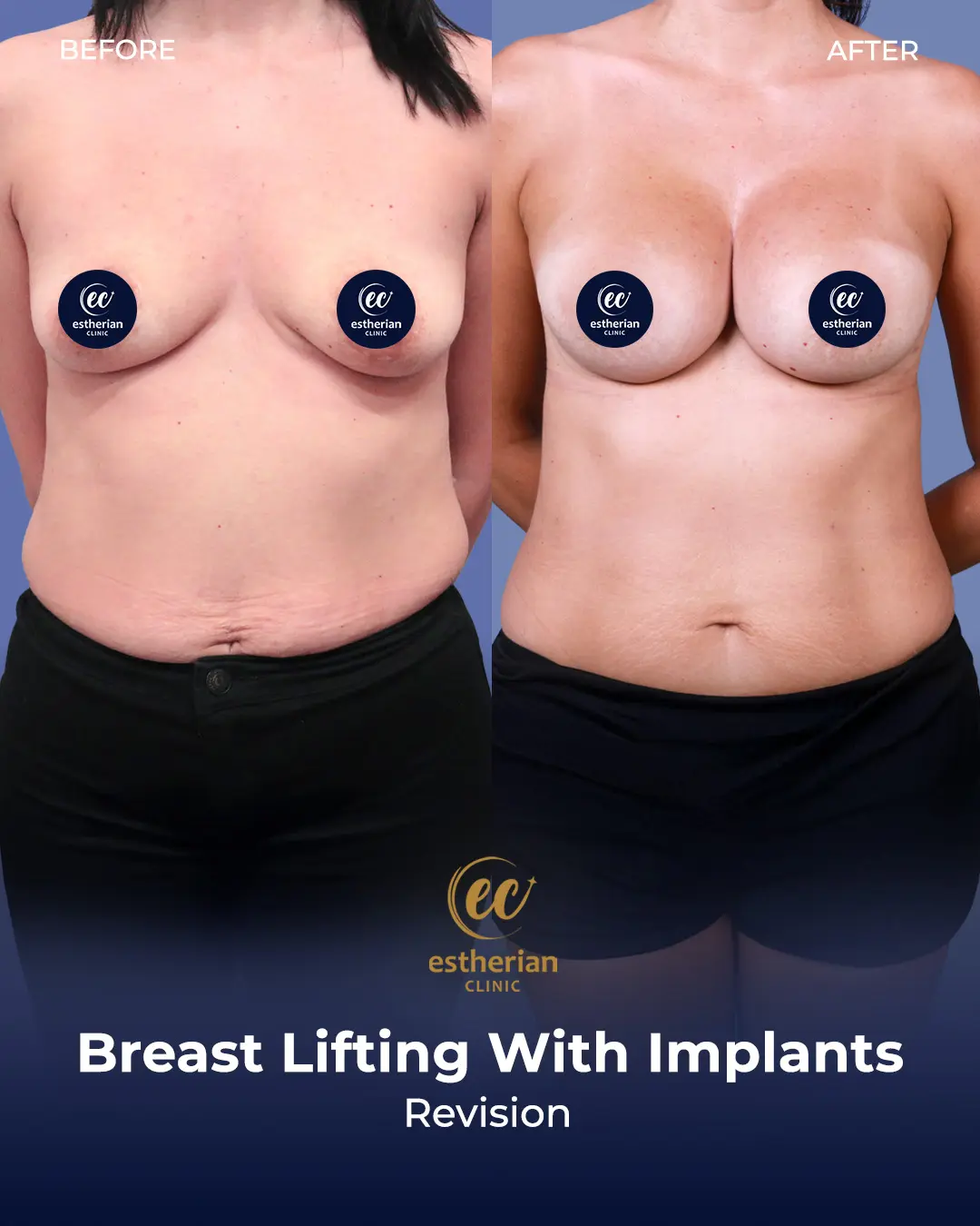 Breast Lift with Implants (Revision)
