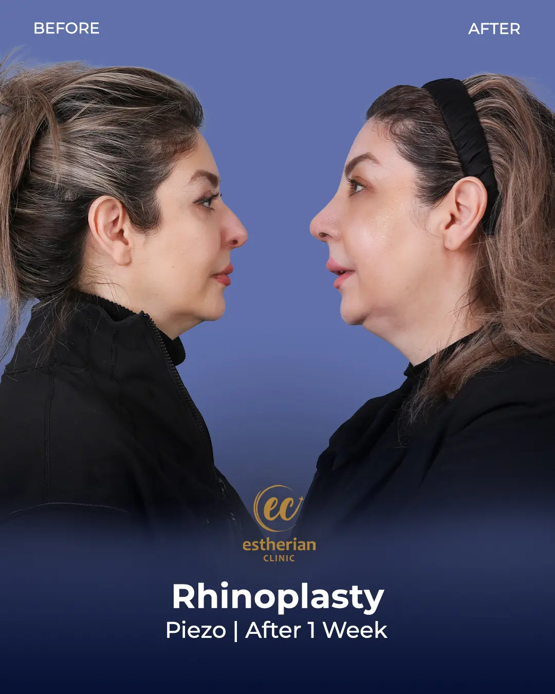 Rhinoplasty Before and After by the Estherian Clinic