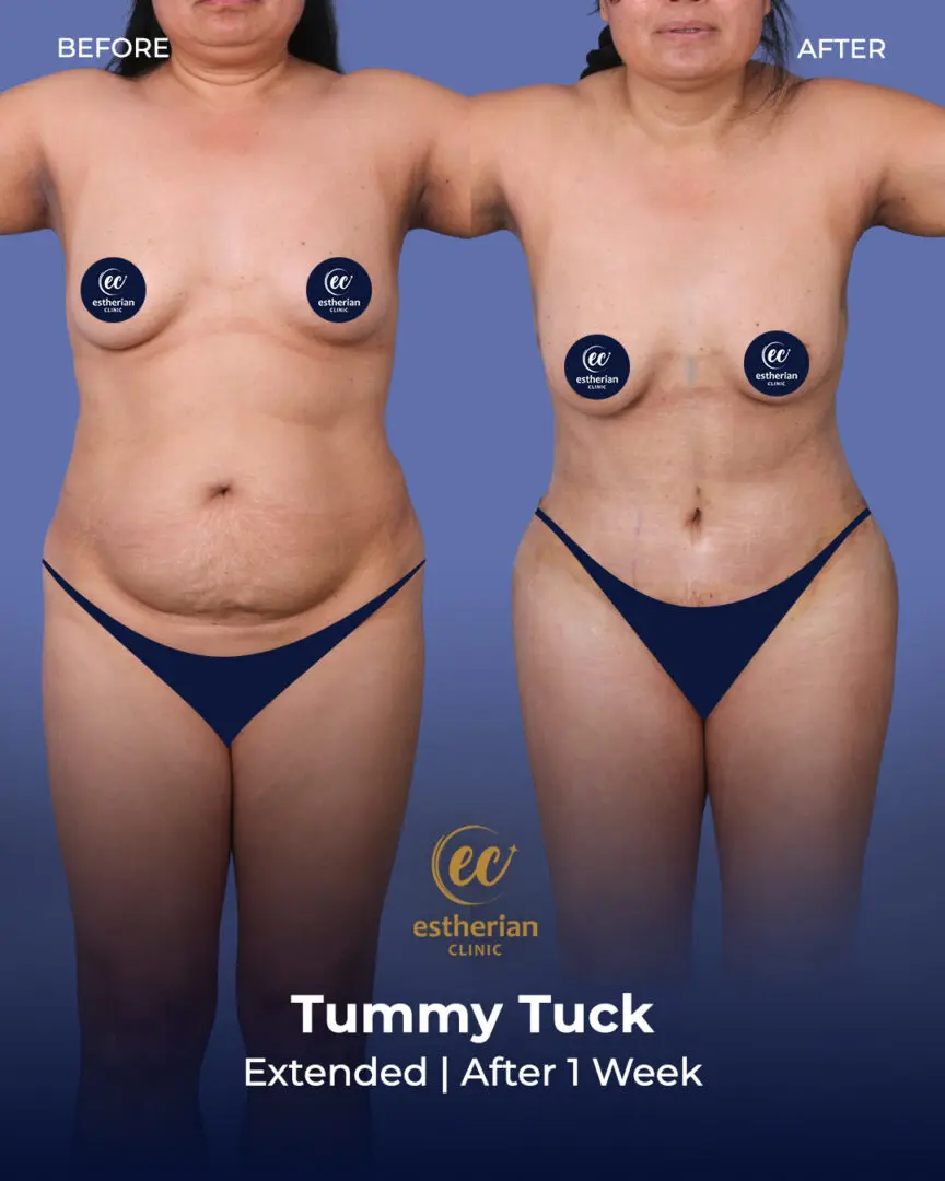 Tummy Tuck Before and after by the Estherian Clinic