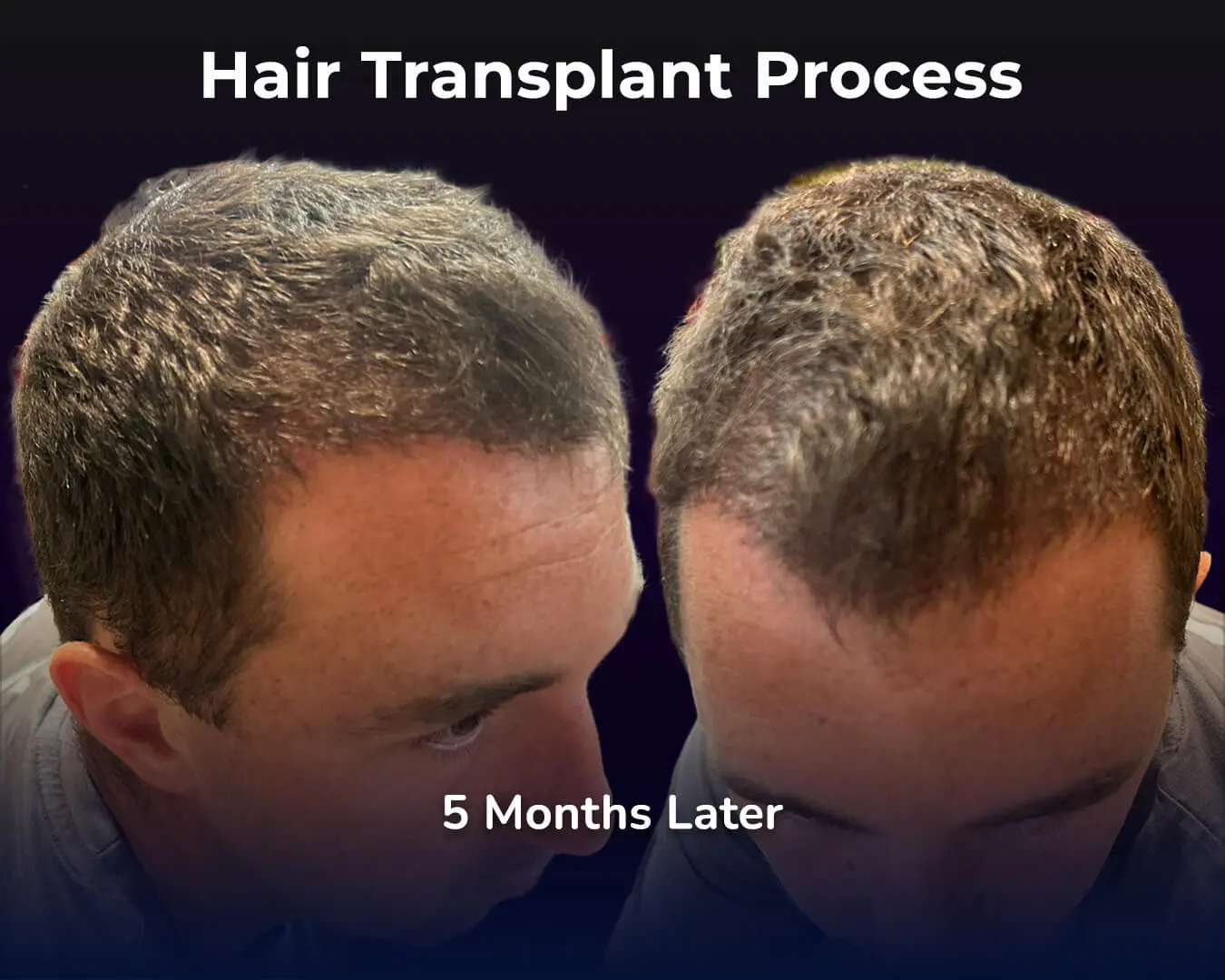 DHI hair transplant Recovery Process - 5 Month Progress
