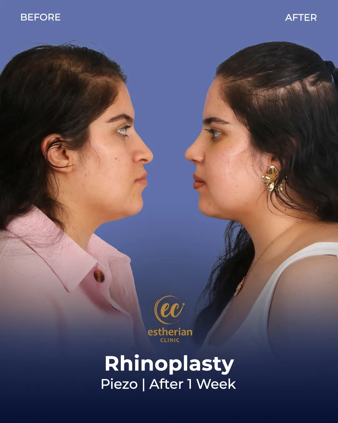Rhinoplasty Before and After by the Estherian Clinic