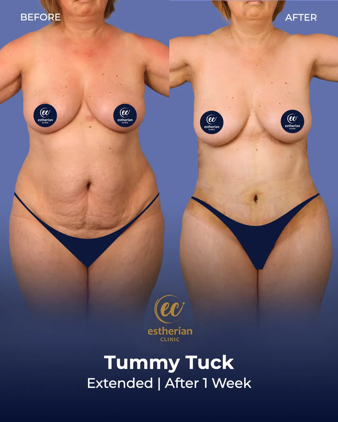 Tummy Tuck Before and after by the Estherian Clinic