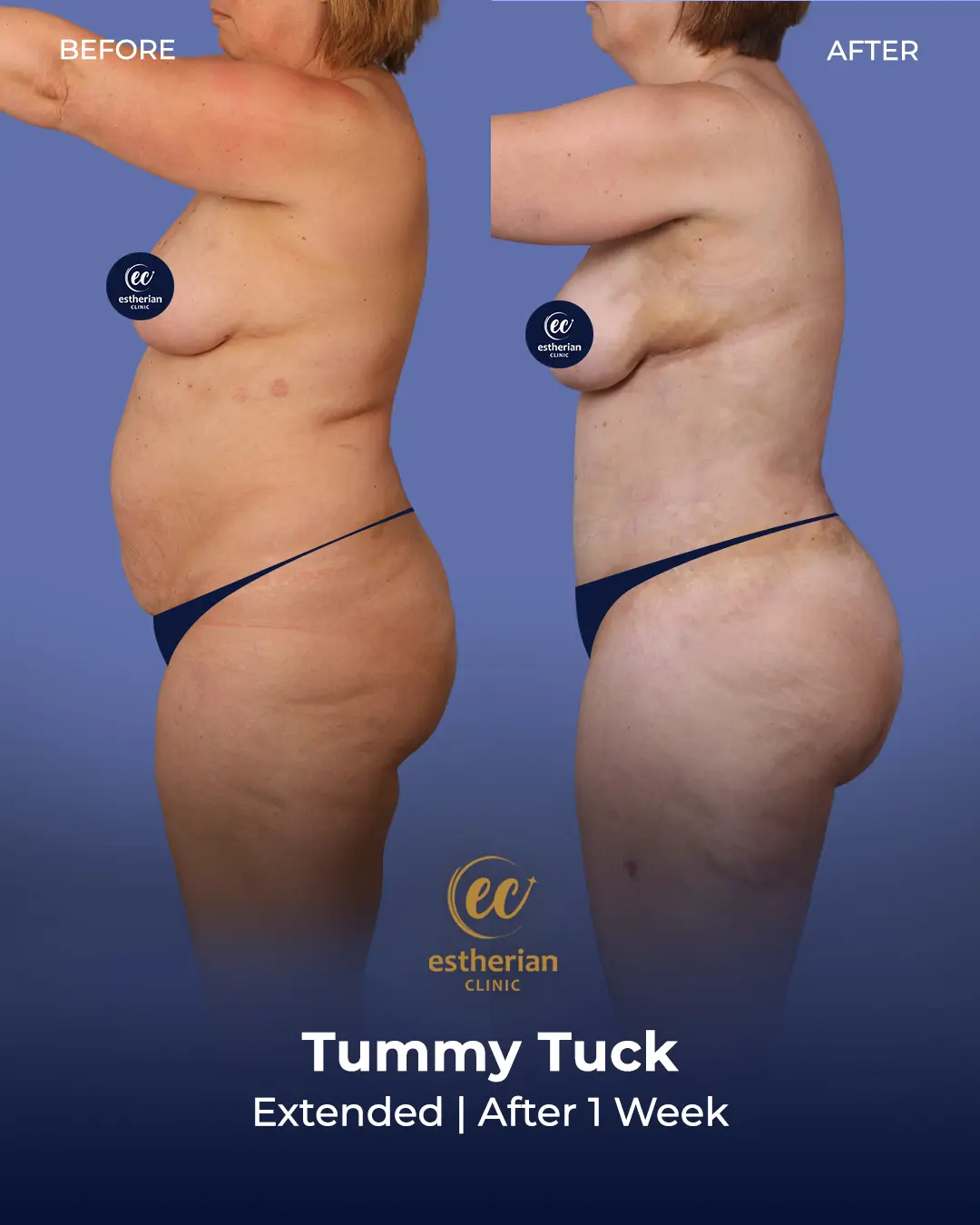 Tummy Tuck Before and after by the Estherian Clinic