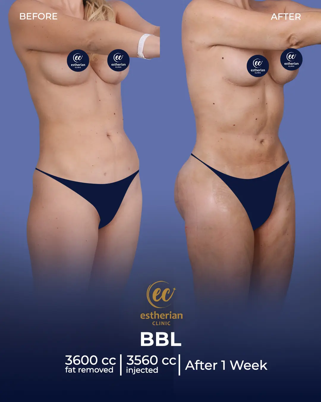BBL - Brazilian Butt Lift Results by the Estherian Clinic