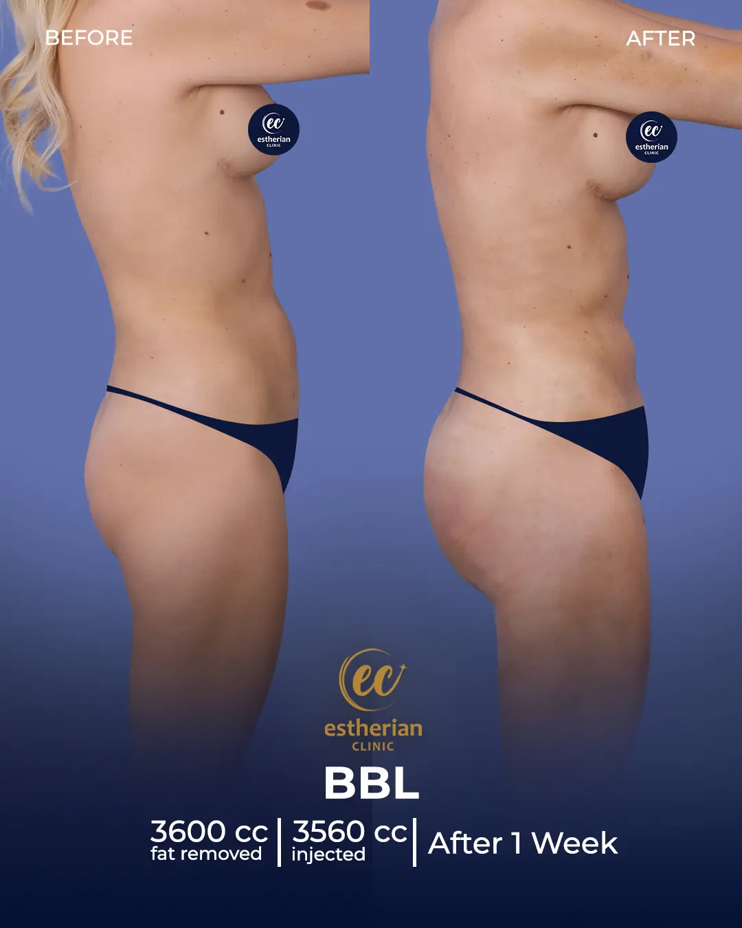 BBL - Brazilian Butt Lift Results by the Estherian Clinic