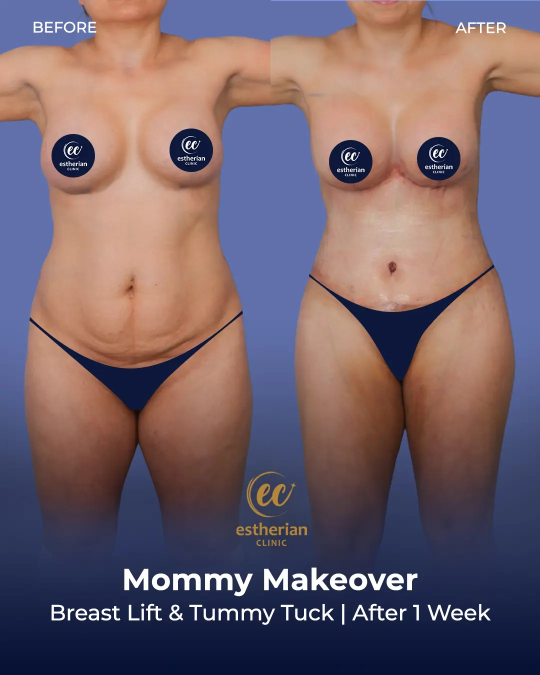 Body Contouring Surgery (before and after) by the Estherian Clinic
