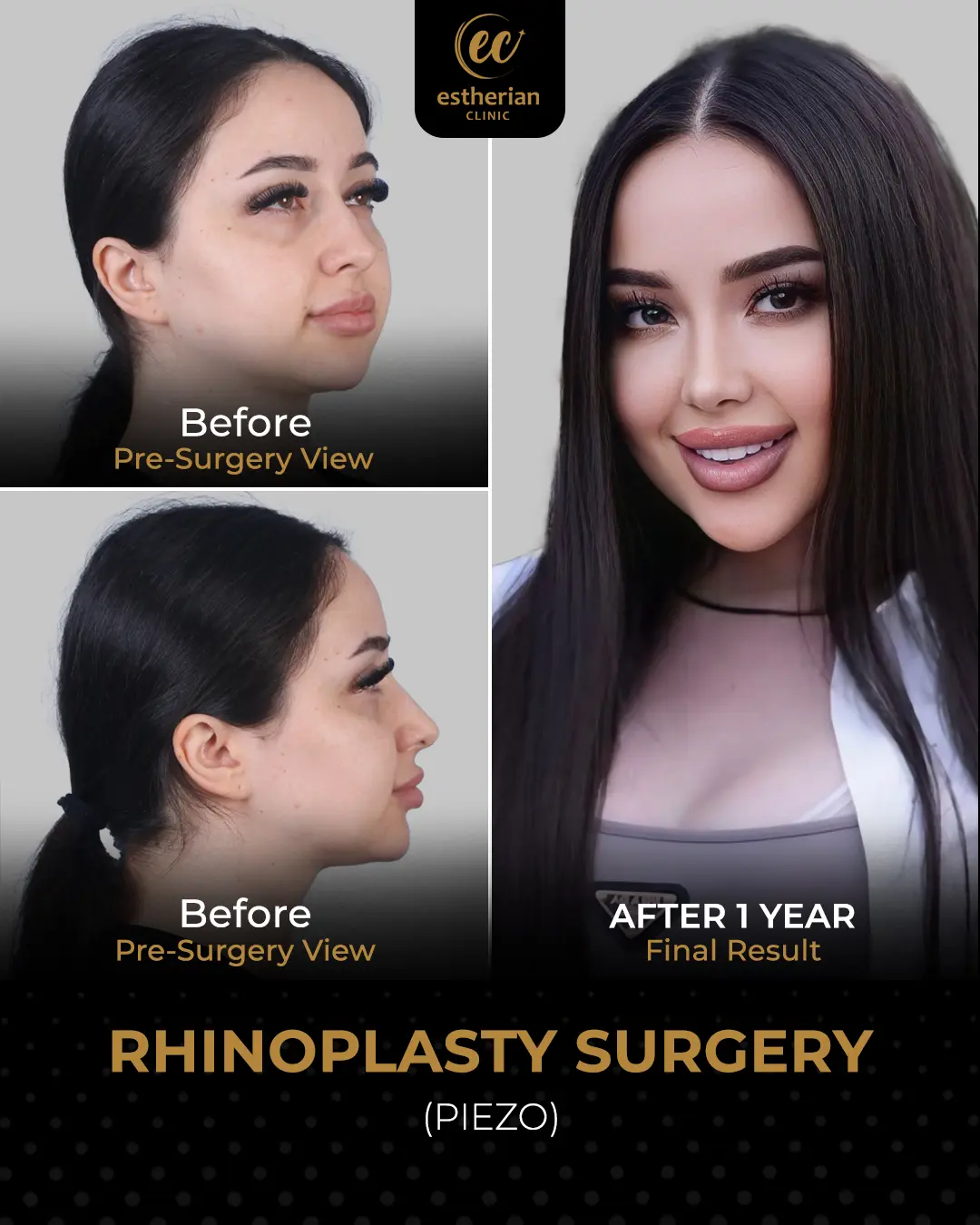 Rhinoplasty Before and After by the Estherian Clinic