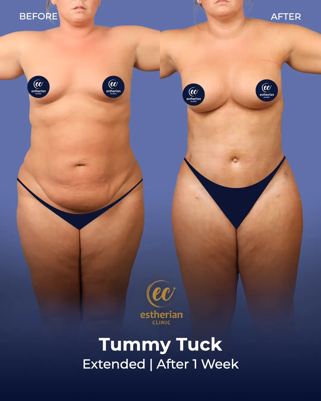 Tummy Tuck Before and after by the Estherian Clinic