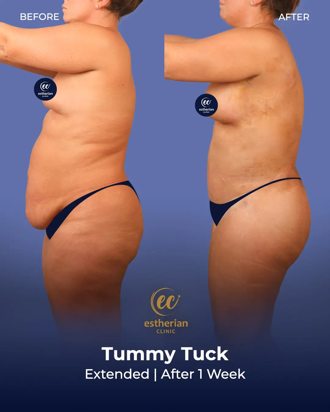 Tummy Tuck Before and after by the Estherian Clinic